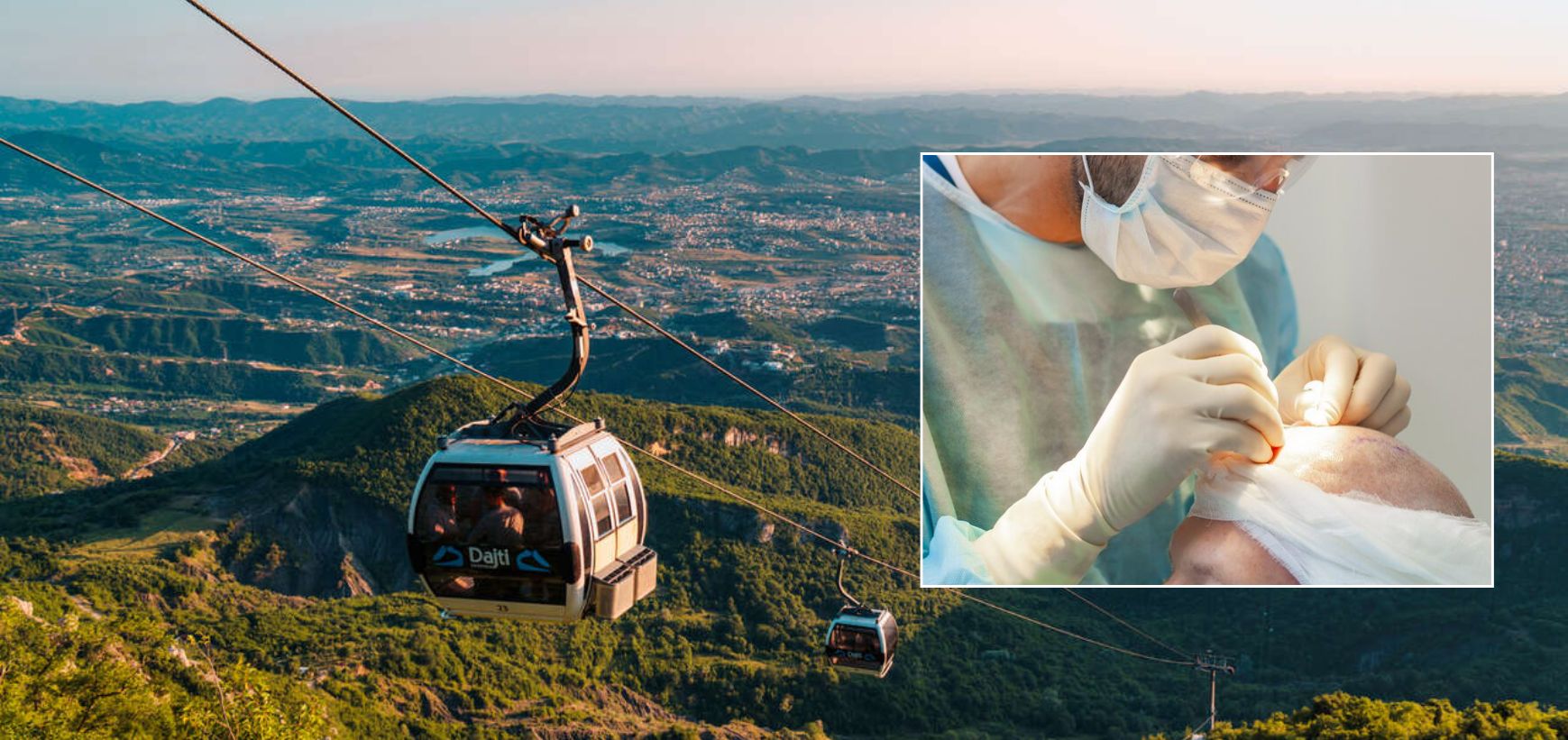 Hair Transplant & Vacation In Tirana While You Heal
